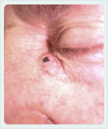 Bösartiger Hauttumor im linken Nasenwinkel