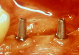 Zwei Implantate mit Aufbaupfosten 