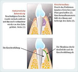 Parodontose - Behandlung
