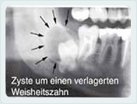 retinierter Zahn